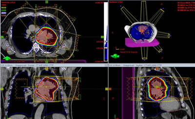 Simulation and Treatment Planning